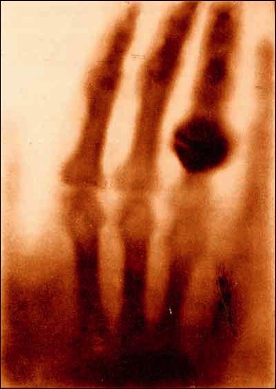 Ảnh chụp tia X đầu tiên, 1895
