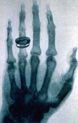 Roentgen-x-ray-von-kollikers-hand